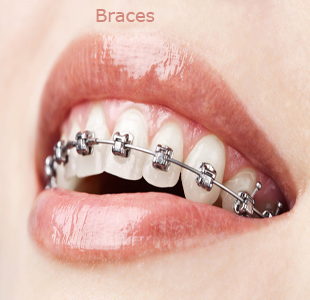 braces